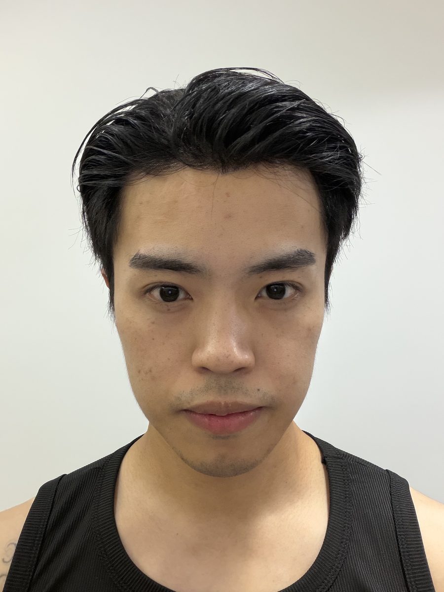 Front view of the fitted hair system, showing the hairline