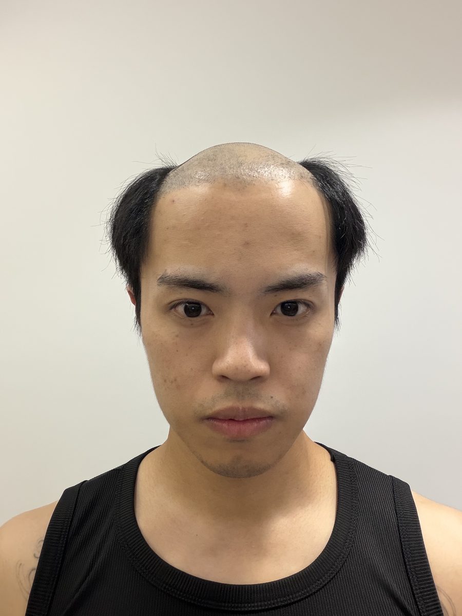 Client's hairline before wearing a hair system