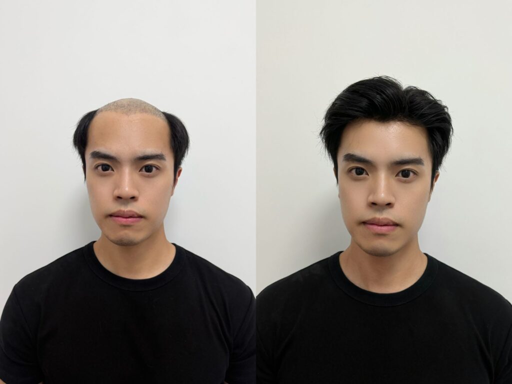 Custom Men's Hair System — Virgin Human Hair